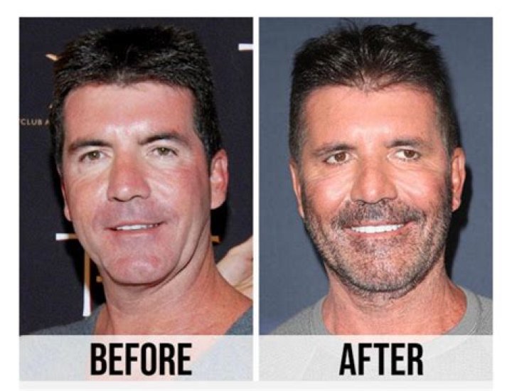Has Simon Cowell Had A Stroke? His Illness And Health Update